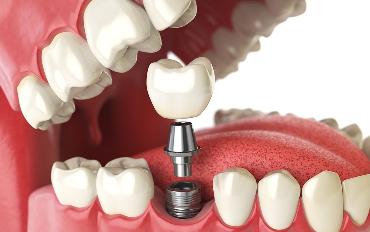69011eeb4013446c6b3fd309_implante-dentario-preco