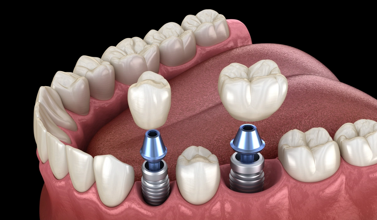 Dental Implants: When are they necessary and what are the benefits?