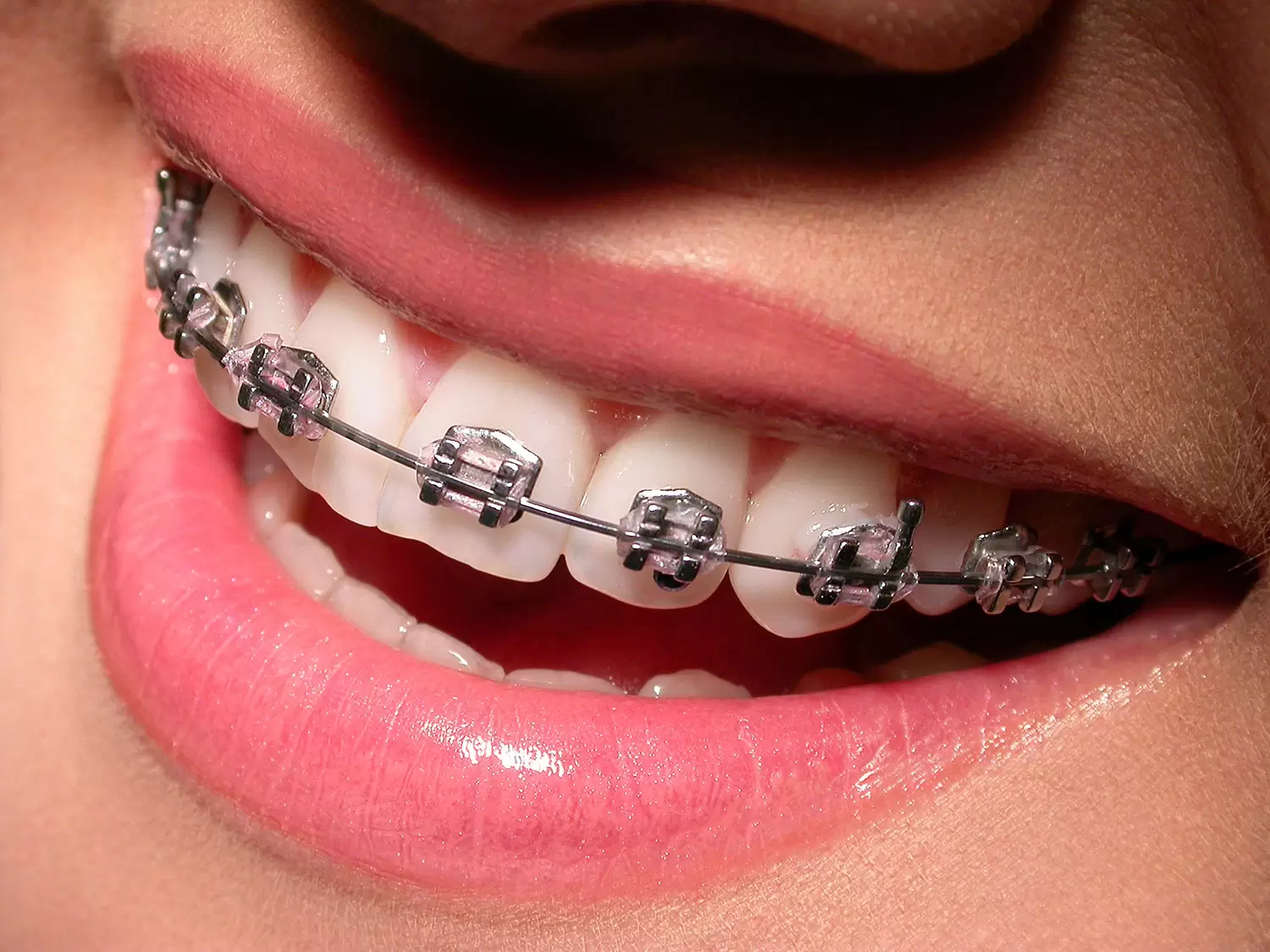 orthodontics-in-turkey