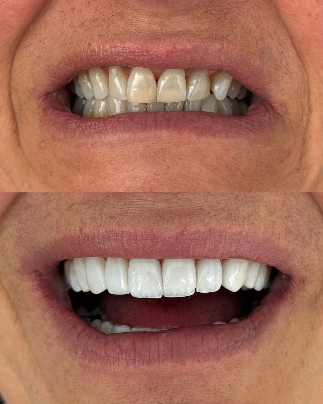Caso clínico real 06 com comparação antes e depois do sorriso