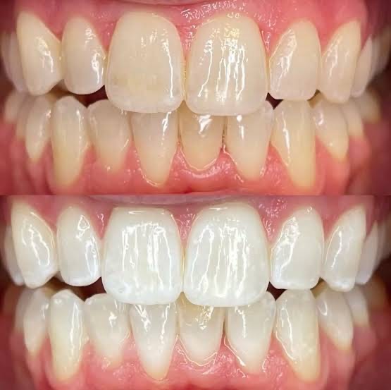 Caso real de clareamento dental na Top Class, antes acima e depois abaixo