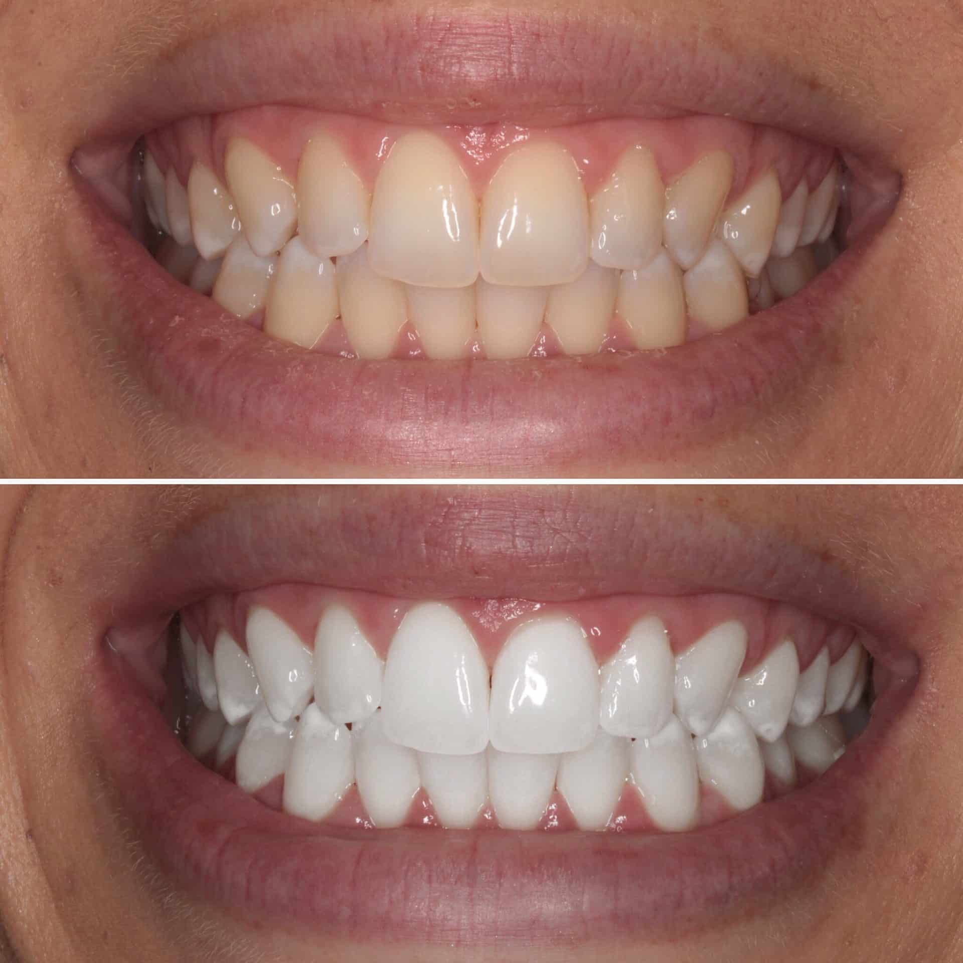 Caso real de clareamento dental na Top Class, antes acima e depois abaixo