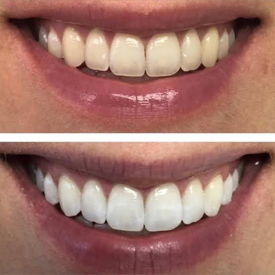 Caso real de clareamento dental na Top Class, antes acima e depois abaixo